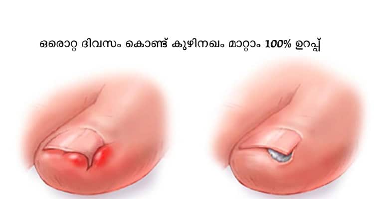Remove Toenail Fungus Only 1 Day